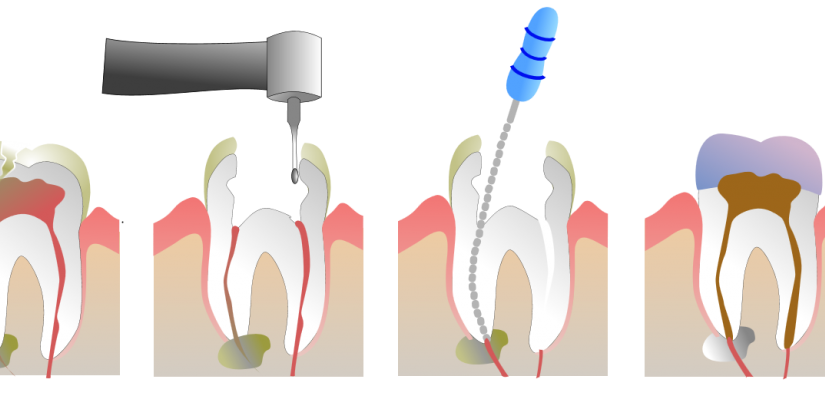 What is a Root Canal?