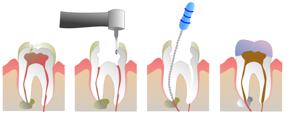 Root_Canal_Illustration_Molar