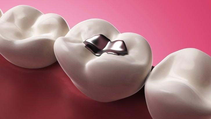 Amalgam-Fillings1-727x4091-727x409