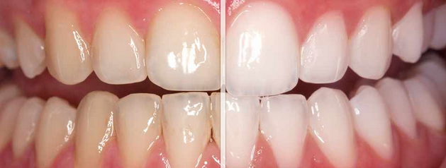 Teeth-Whitening-Before-and-After-Chapel-Hill