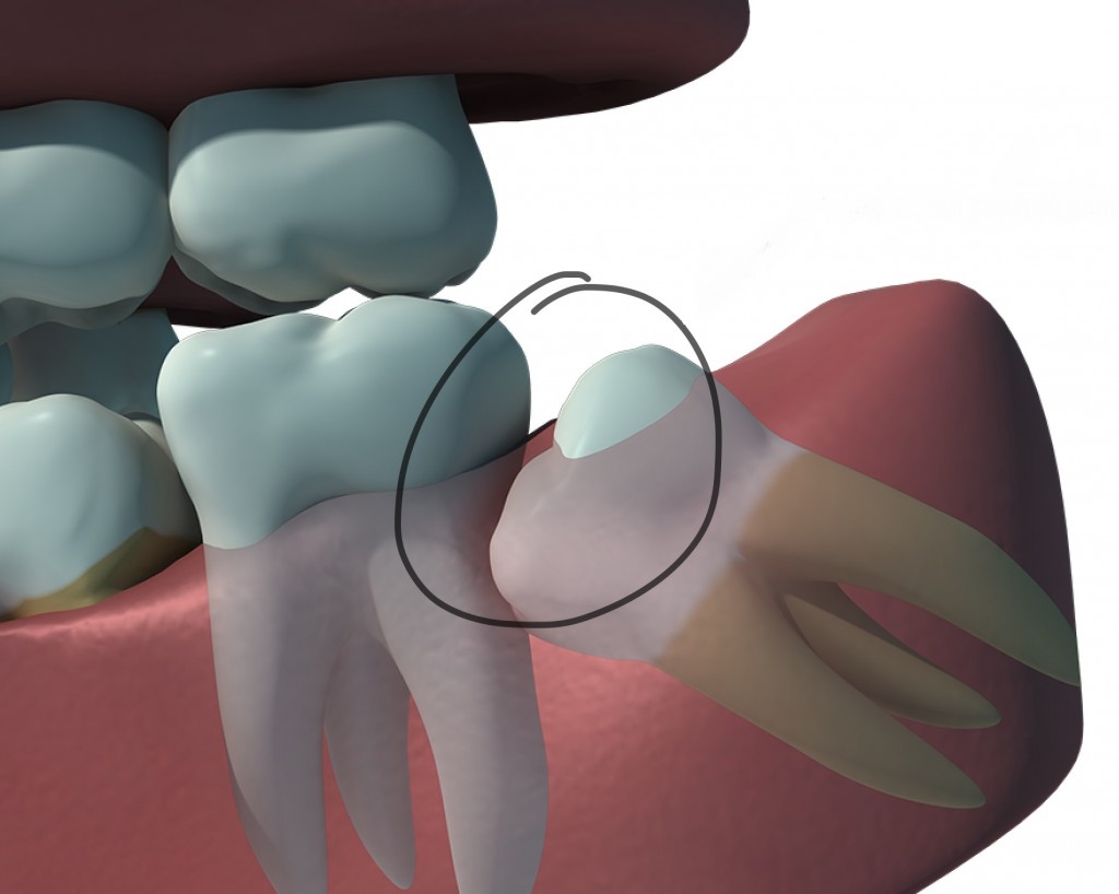 Wsidom Teeth2