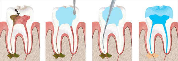 root-canal-filling