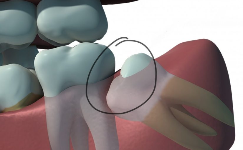 Why Remove Wisdom Teeth?