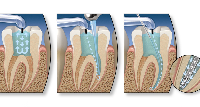 Root Canal Start (First Appointment)