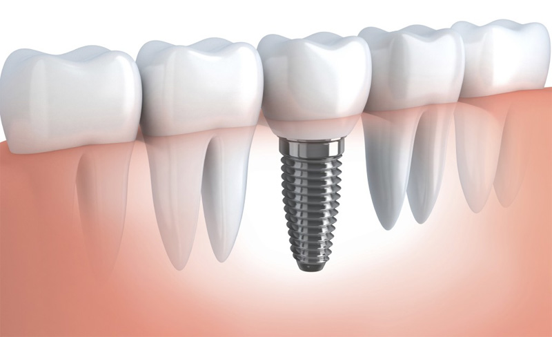 dental-implants1