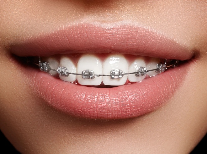 What is the Average Cost for Orthodontic Braces?