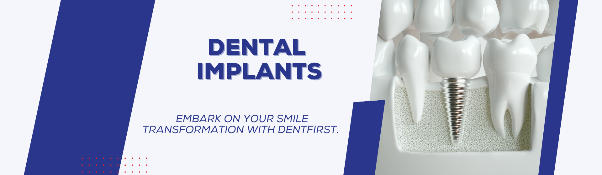 DENTAL IMPLANTS