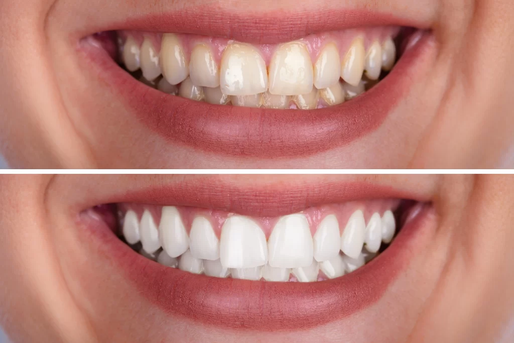 How Much Does it Cost to Get Teeth Professionally Whitened? Dentfirst