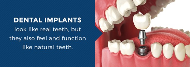 Dental Implants Work